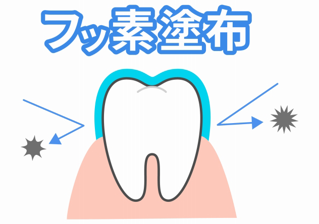 フッ素塗布