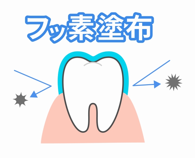 フッ素塗布