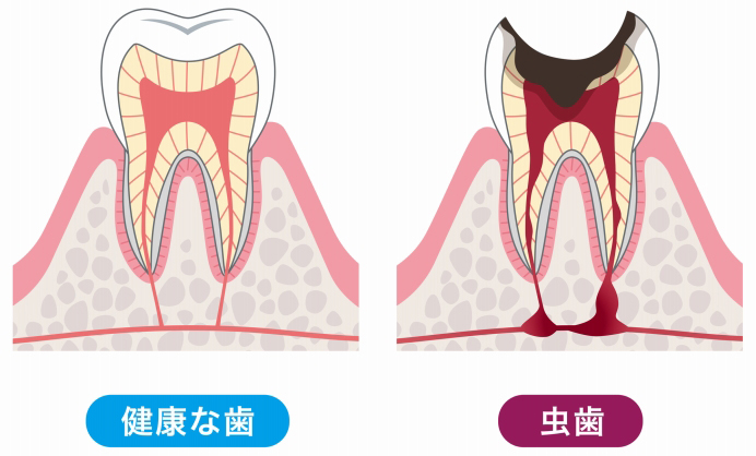 どうしてむし歯になるの？